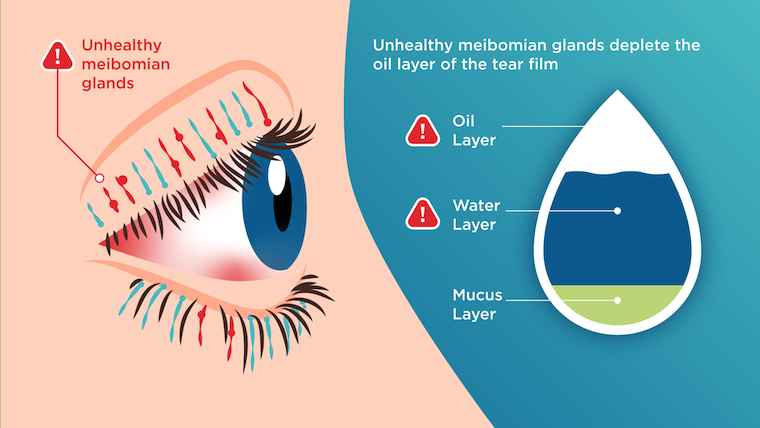 A photo description of unhealthy meibomian glands